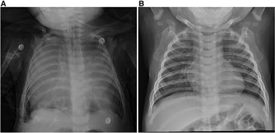 Thoracoscopic approach for massive thymic hyperplasia in an infant: Case report and literature review